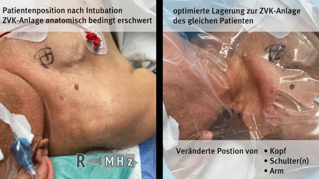 Lagerung zur ZVK Anlage in die V. jugularis interna