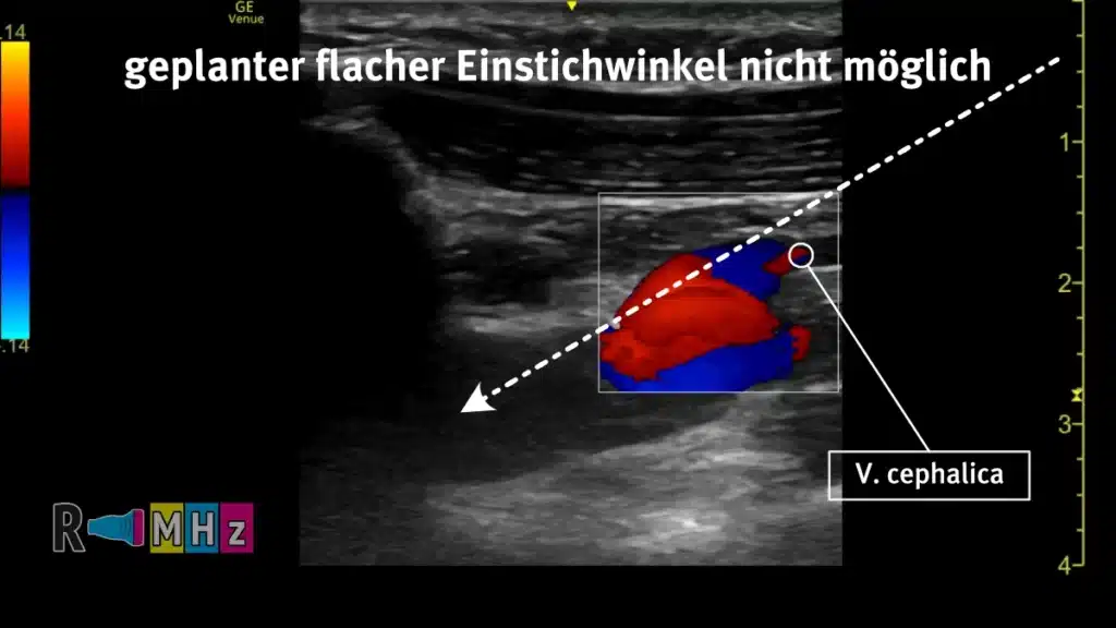 Vena cephalica in Punktionsrichtung für V. subclavia Punktion Radiomegahertz