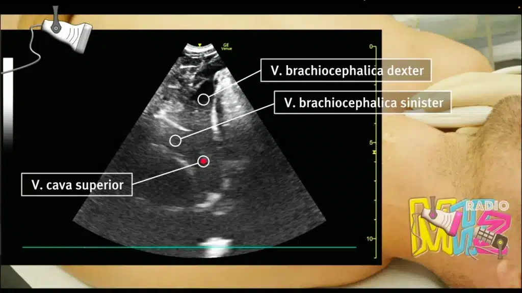 V. brachiocephalica dexter et sinister Radiomegahertz