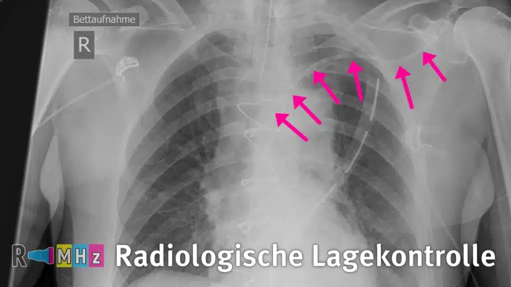 Röntgen Thorax ZVK Kontrolle Radiomegahertz