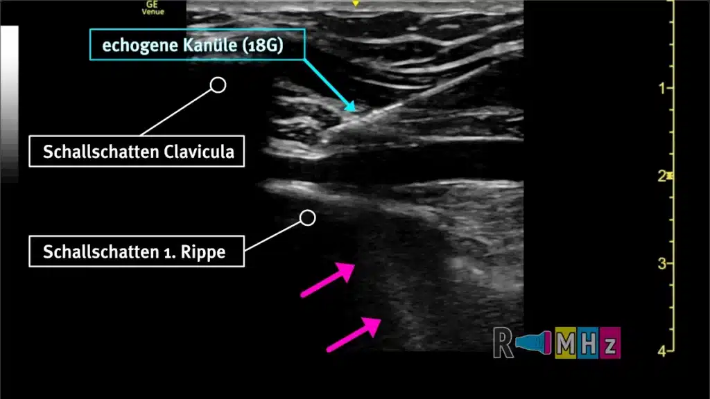 Vascular Sono Pajunk Vena subclavia Punktion Radiomegahertz