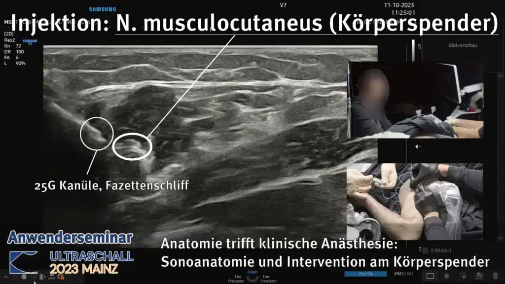 N. musculocutaneus Injektion Körperspender Latex Radiomegahertz
