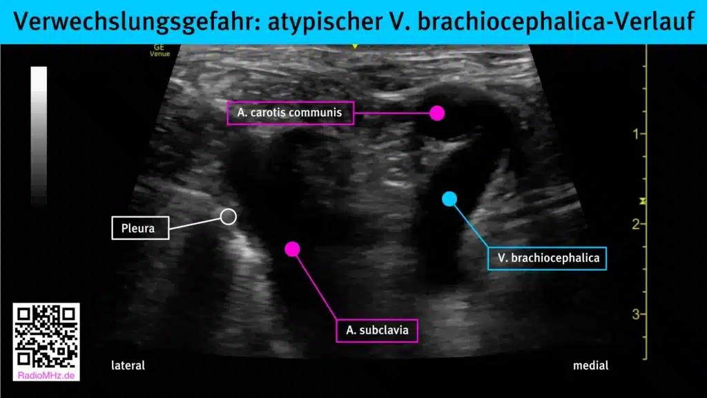 Untypische Position und Verlauf V. brachiocephalica links