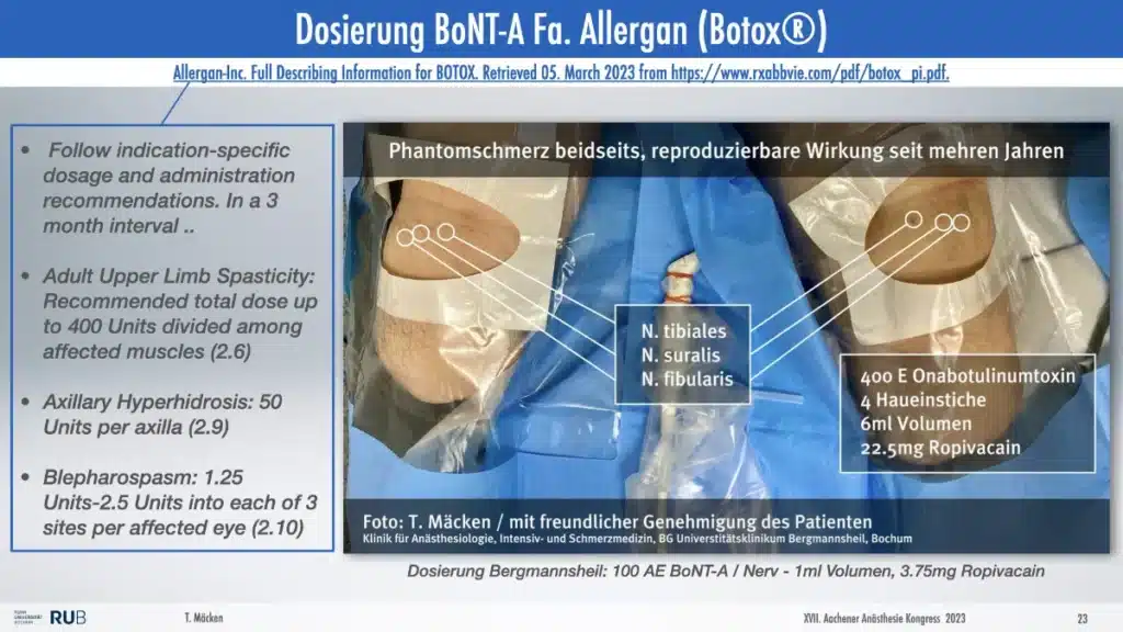 Beidseitige perineurale Botulinum-Toxin Injektion