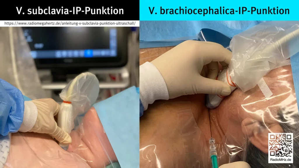 Position Ultraschallsystem in-plane Puntion V. brachiocephalica