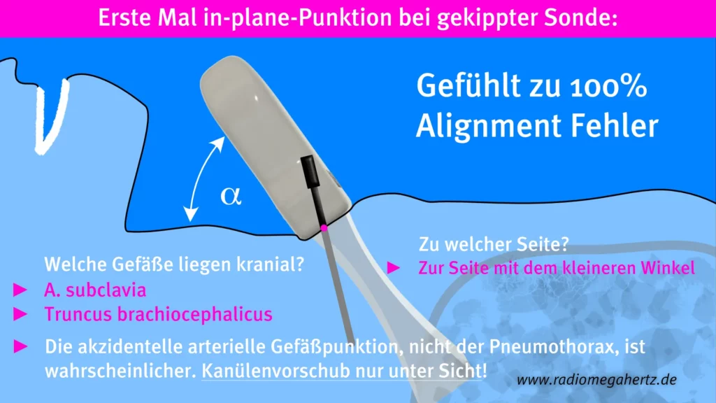 in-plane V. brachiocephalica Punktion bei gekippter Sonde Radiomegahertz