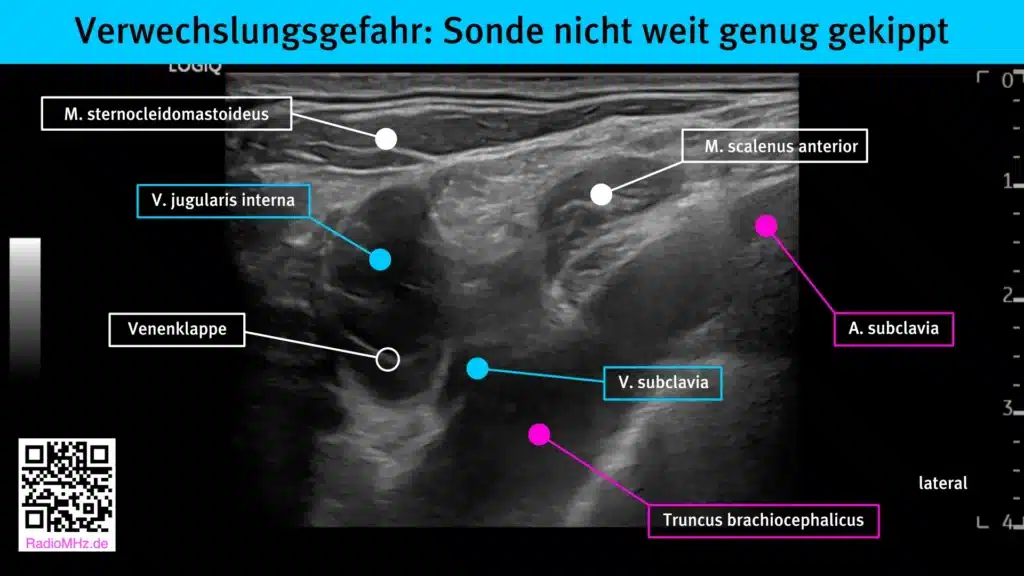 Verwechslung von Truncus brachiocephalicus und Vena brachiocephalica