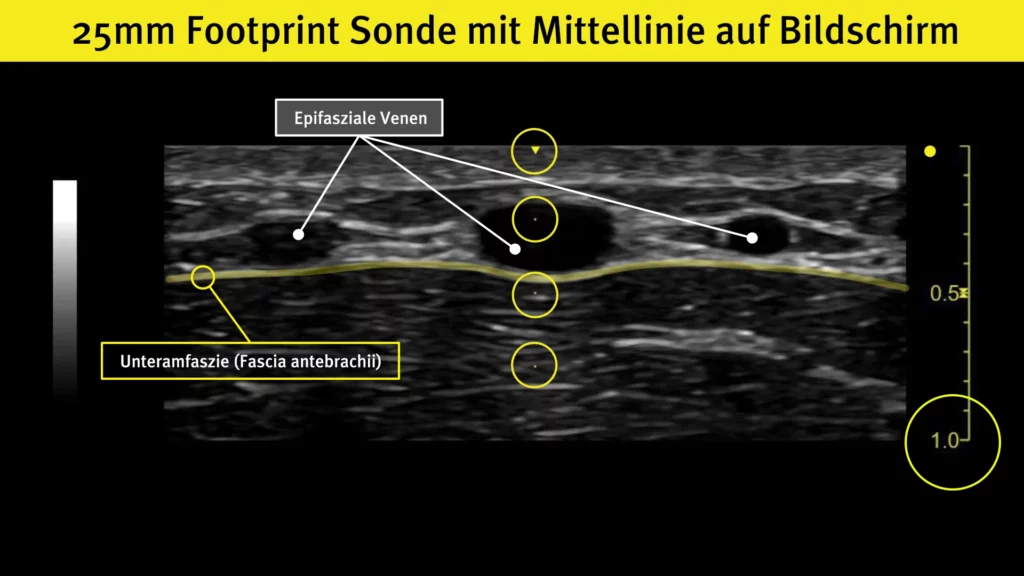 Werden nur 25mm vom Patienten auf dem gesamten Bildschirm dargestellt, kannst du besser periphere Venen punktieren | Radiomegahertz