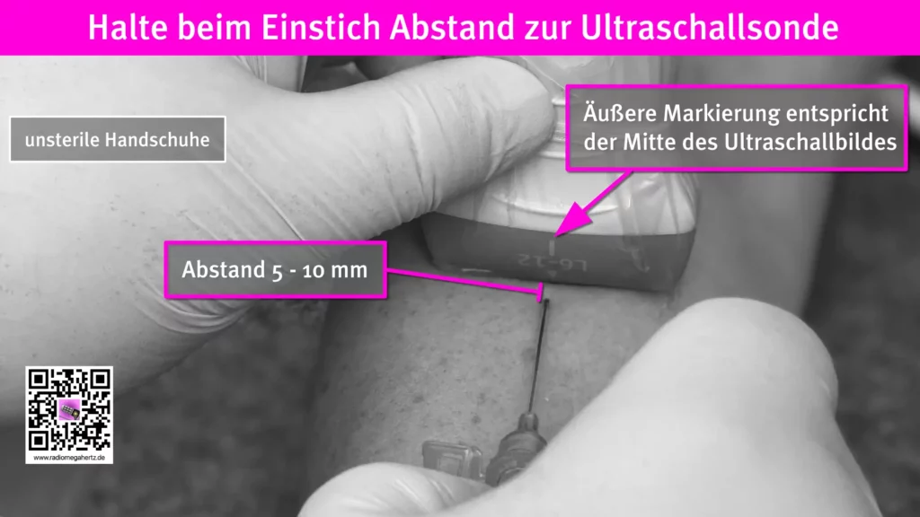 Halte Abstand zur Ultraschallsonde ein, wenn der Überzug nicht sterile ist. Radiomegahertz