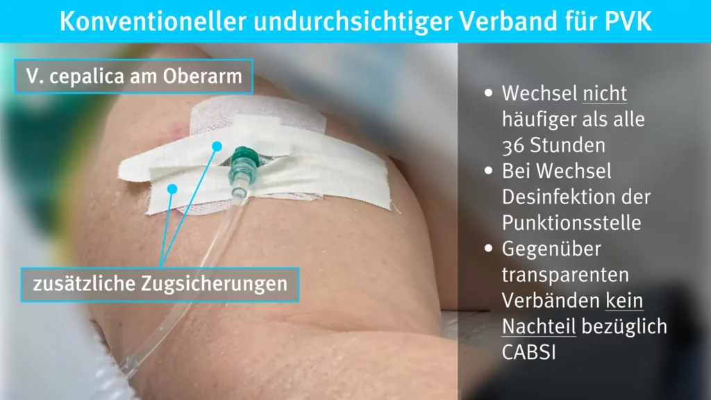 Konventioneller undurchsichtiger Verband für periphere Verweilkanülen / Radiomegahertz