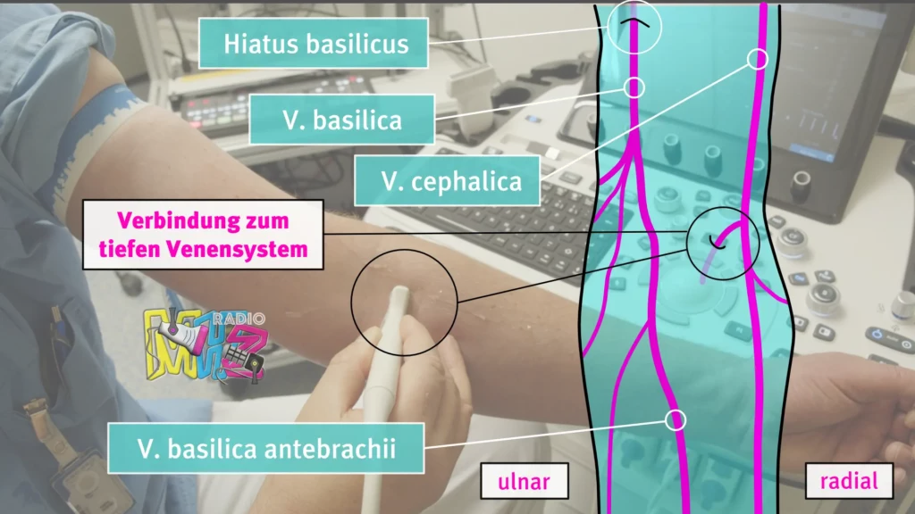 Eigene Sonpgraphie der peripheren Venen am Unterarm Radiomegahertz