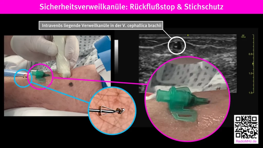 Sicherheitsverweilkanüle für peripheren Venenpunktionen Radiomegahertz Ultraschall