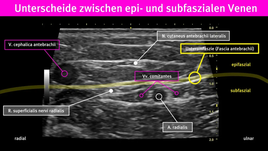 keine Verweilkanüle in tiefe periphere Venen am Unterarm Radiomegahertz