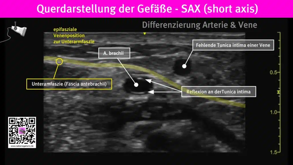 Unterscheide Venen von Arterien durch die Reflexion in der Fossa cubiti | Radiomegahertz