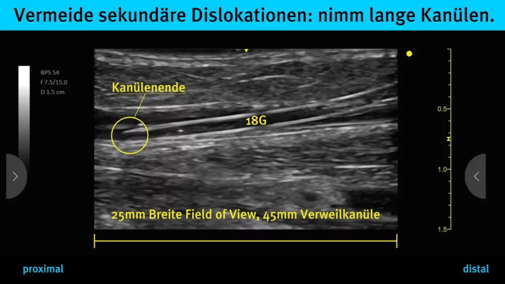 Durch lange Verweilkanülen vermeidest du sekundäre Dislokationen bei der peripheren Venenpunktion | Radiomegahertz