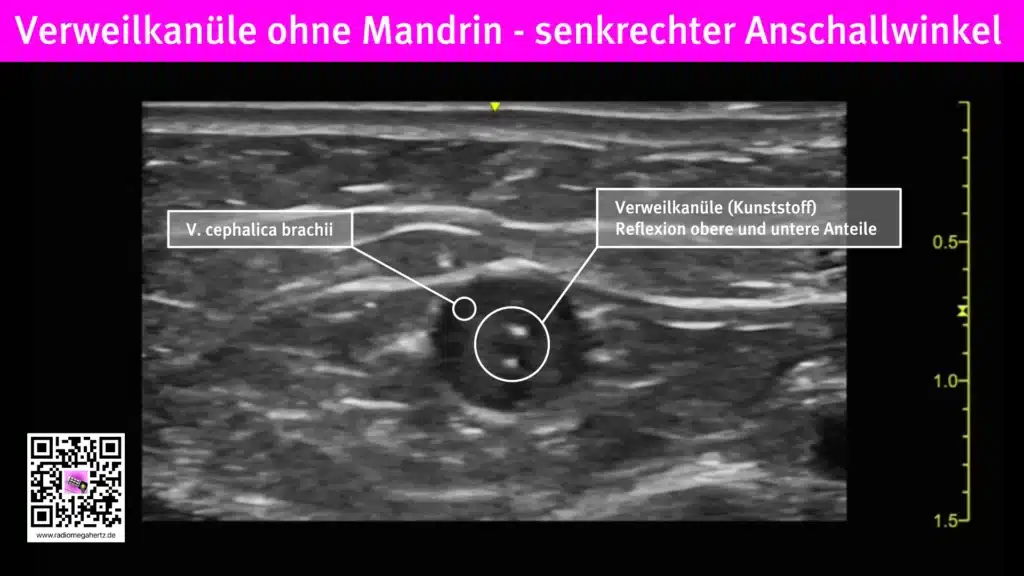 Intravenös liegende Verweilkanüle ohne Mandrin, gute sonografische Sichtbarkeit | Radiomegahertz