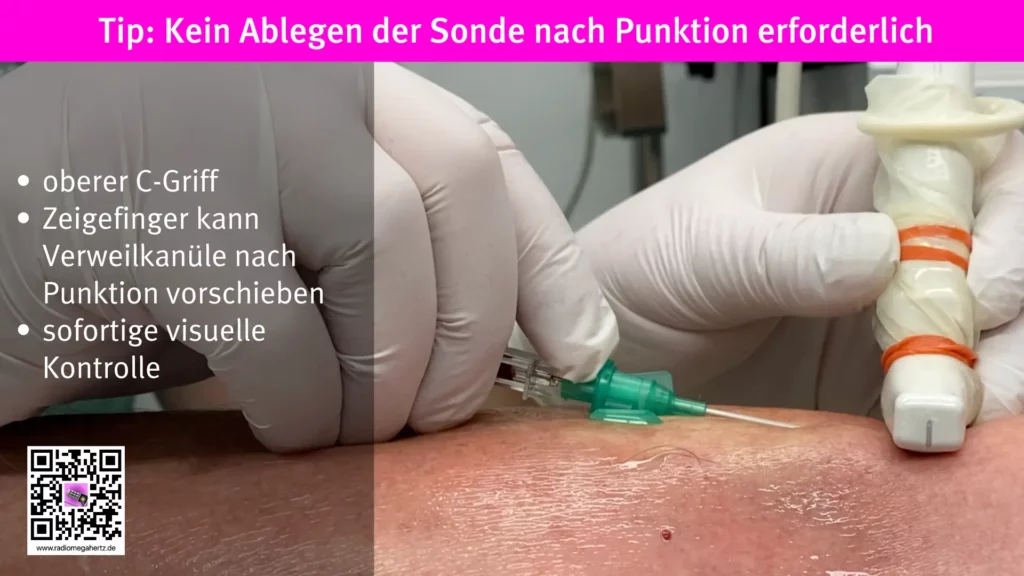 Punktion und sonografische Kontrolle der peipheren Verweilkanüle zugelich. Radiomegahertz