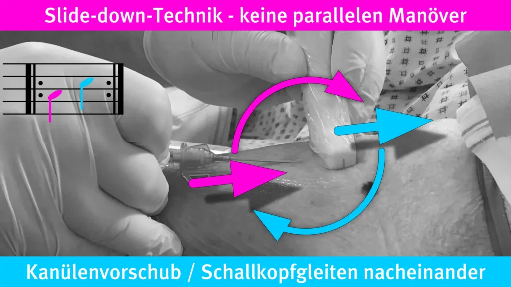 Beschreibung der slide down Technik zur peripheren Venepunktion auf Radiomegahertz