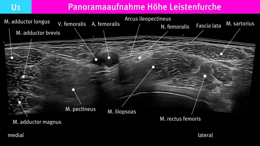 Ultraschallbild von der medialen zur lateral Leistenregion auf Höhe der Leistenbeuge für die Punktion. Radiomegahertz