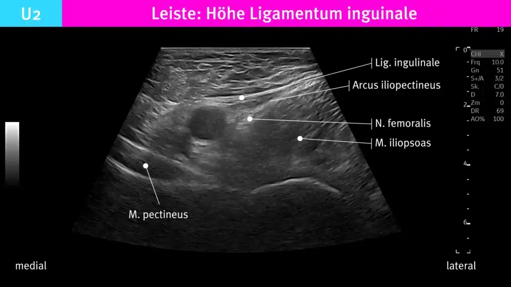 Ultraschallaufnahme auf Höhe des Leistenbandes. Radiomegahertz