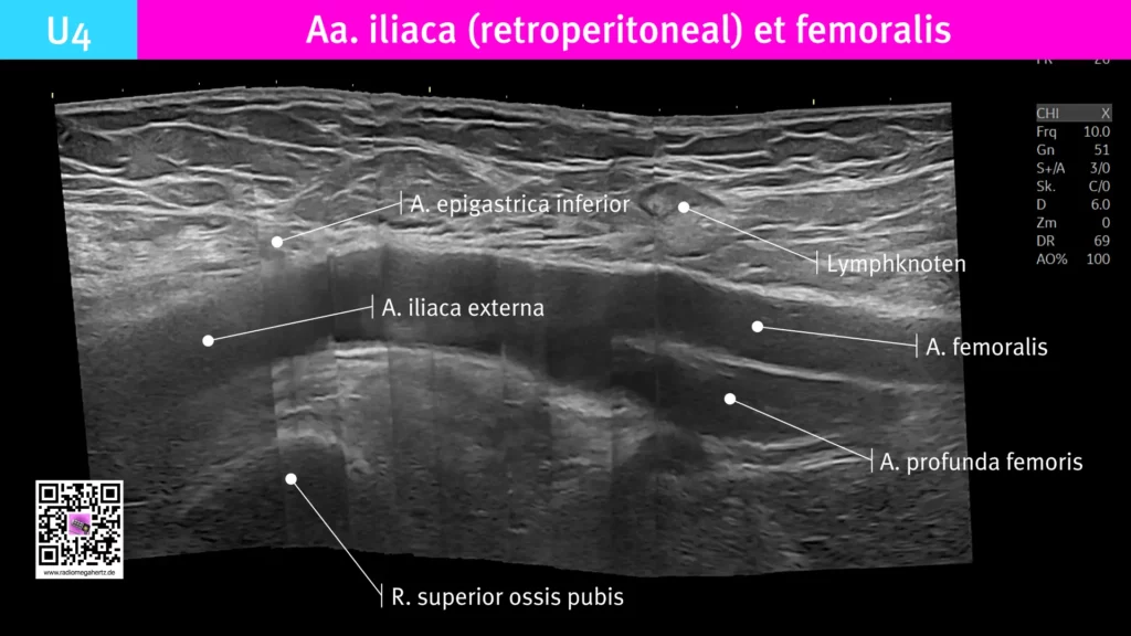 Panoramaaufnahme der A. iliaca externa im Übergang zur A. femoralis. Radiomegahertz