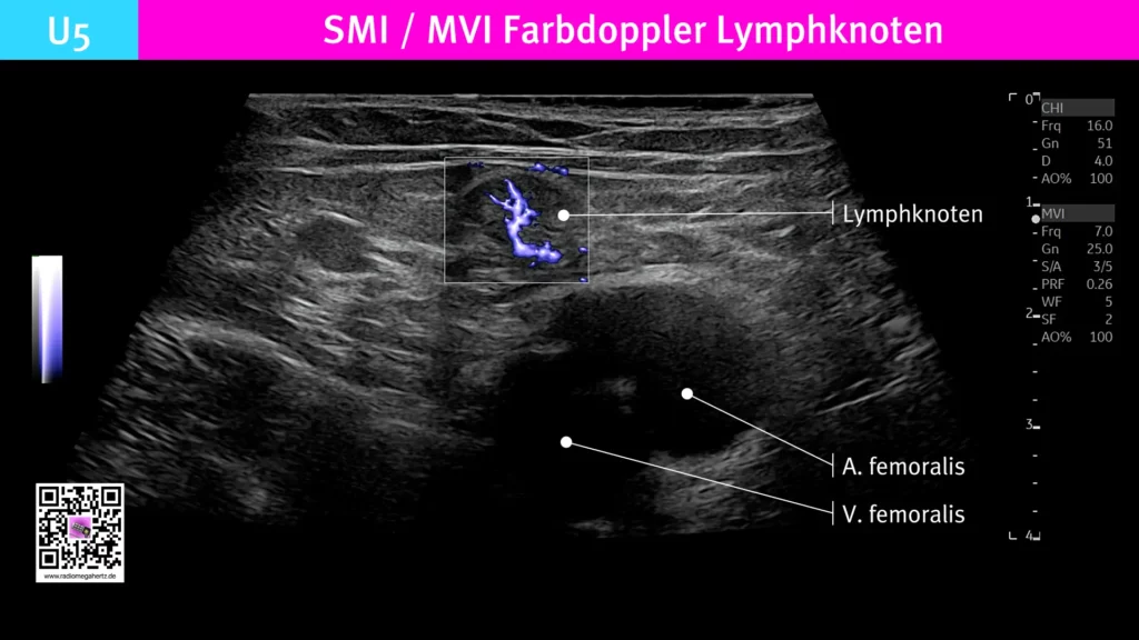 Hochauflösender Farbdoppler für langsame Blutflüsse eines Lymphknotens in der Leistenregion. Radiomegahertz.de