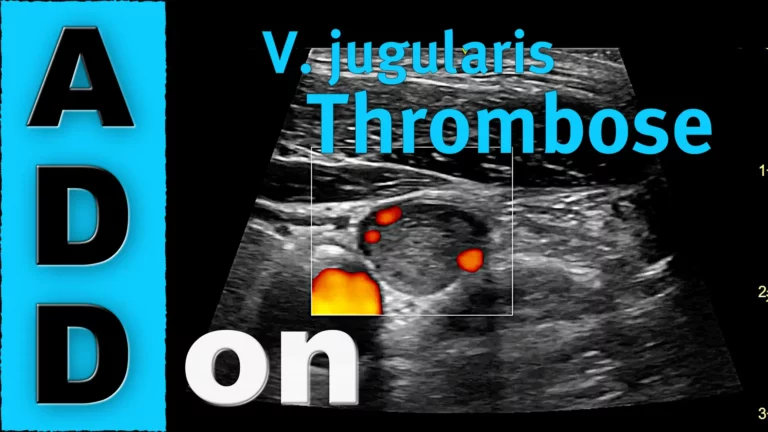 V. jugularis Thrombose: nur ein Nebenbefund?