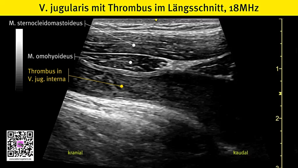 Längsdarstellung der V. jugularis interna mit sichtbarer Ausdehnung des Thrombus nach kaudal in Richtung V. brachiocephalica. Radiomegahertz