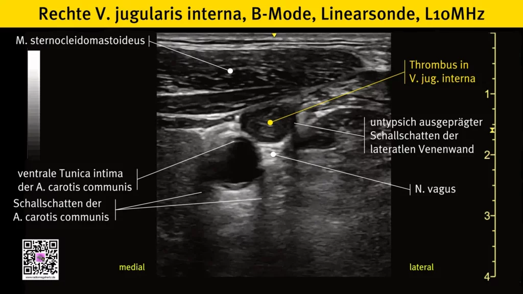 Thrombose der rechten V. jugularis interna. Darstellung mit einem regulären Linearschallkopf mit 10MHz. Radiomegahertz.