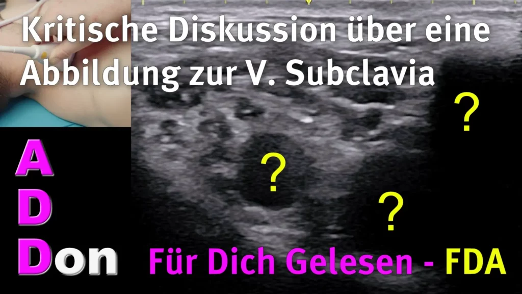 In diesem Video bespreche ich, ob die Abbildung einer Publikation von Schmidt et al. stimmt, dass die dorsale Schallauslöschung der 1. Rippe verhindert, die V. subclavia punktieren zu können.