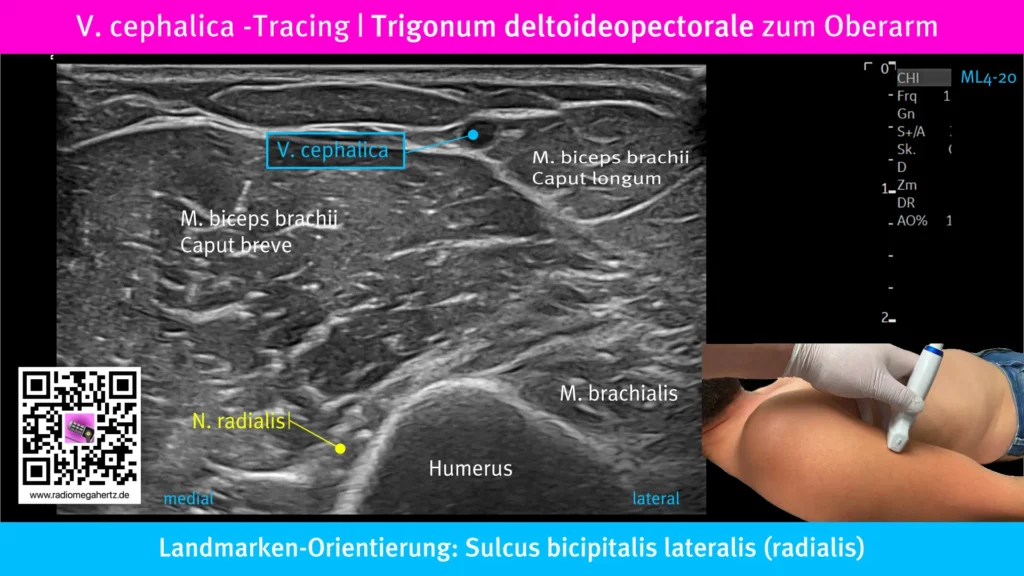 Die Vena cephalica kann vom Trigonum deltoideopectorale zum Humerus verfolgt werden. Als Leitstruktur dient der Sulcus bicipitalis medialis. Radiomegahertz